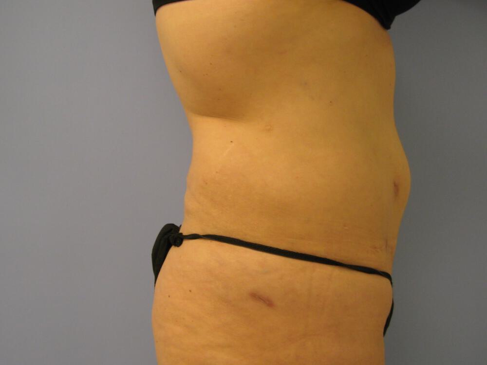 Revision tummy tuck Before & After Image