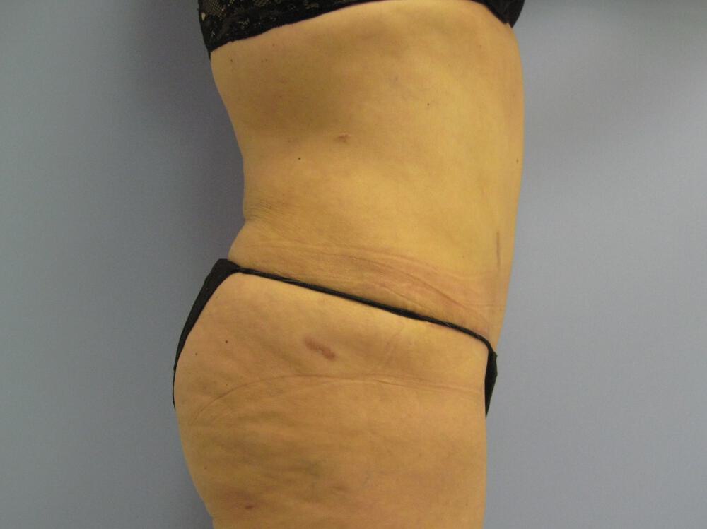 Revision tummy tuck Before & After Image