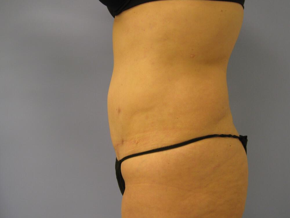 Revision Tummy Tuck Before & After Image