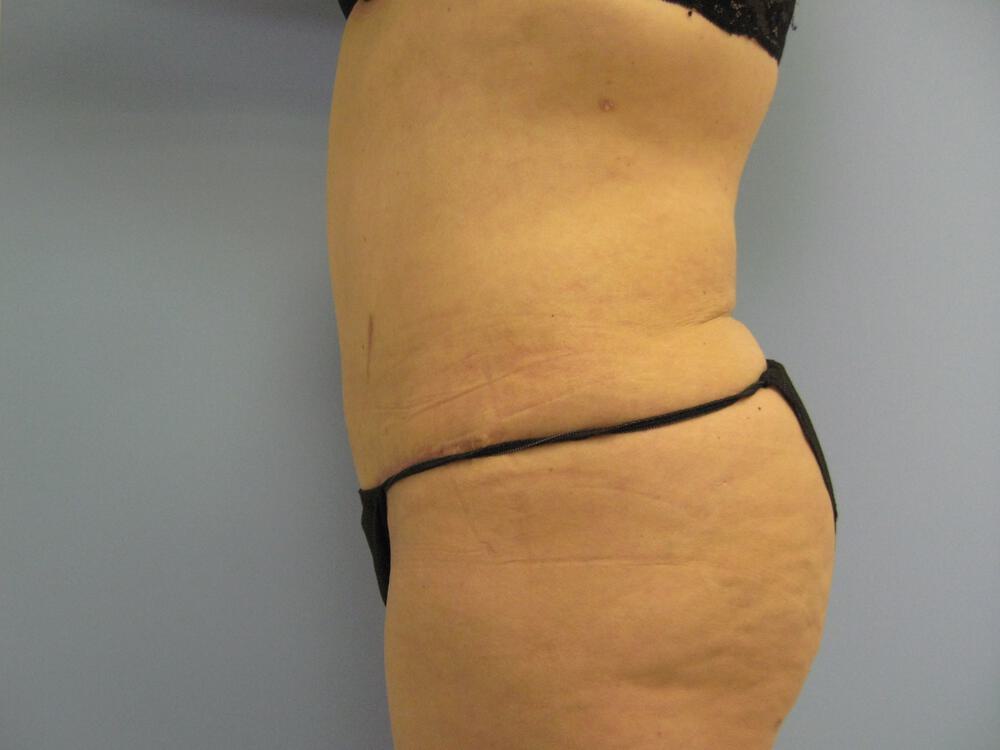 Revision Tummy Tuck Before & After Image