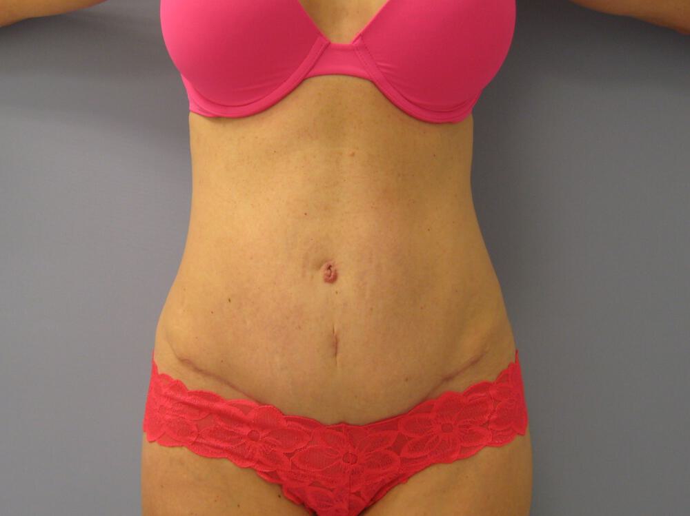Revision tummy tuck Before & After Image
