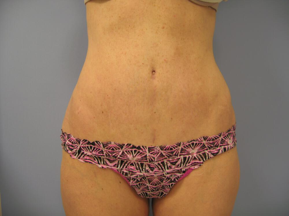 Revision tummy tuck Before & After Image