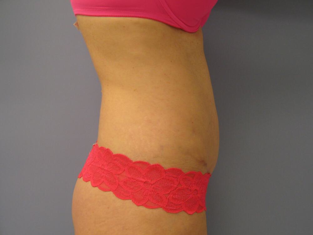 Revision tummy tuck Before & After Image
