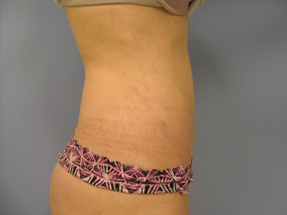 Revision tummy tuck Before & After Image