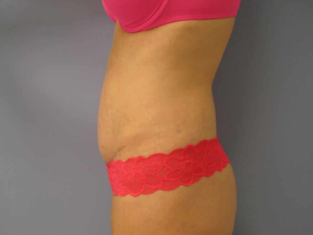 Revision Tummy Tuck Before & After Image
