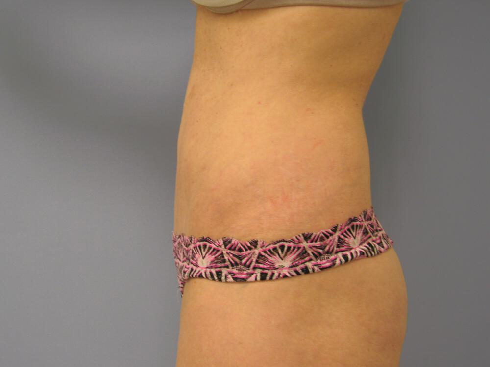 Revision Tummy Tuck Before & After Image