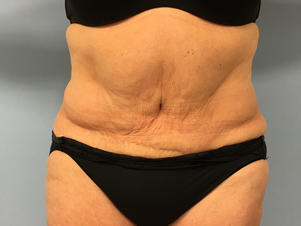 Revision tummy tuck Before & After Image