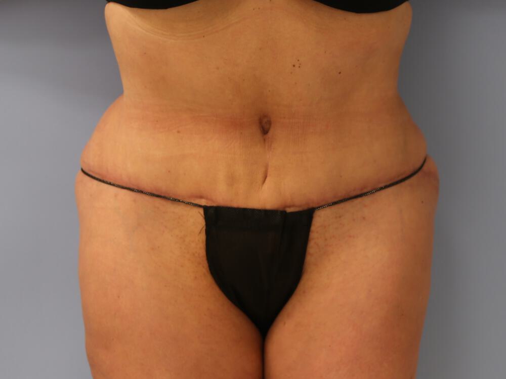 Revision tummy tuck Before & After Image