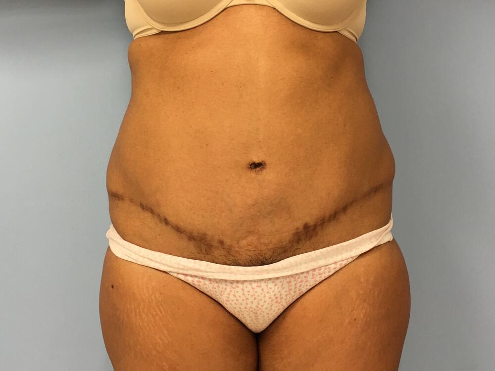 Revision tummy tuck Before & After Image