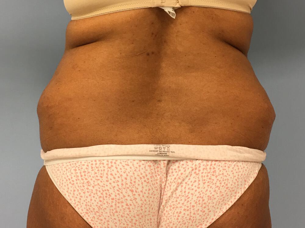 Revision tummy tuck Before & After Image