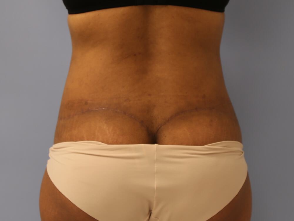 Revision tummy tuck Before & After Image