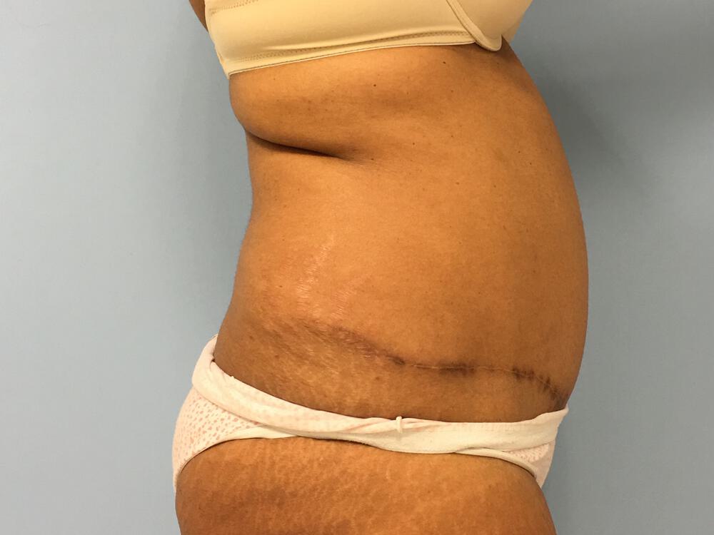 Revision Tummy Tuck Before & After Image