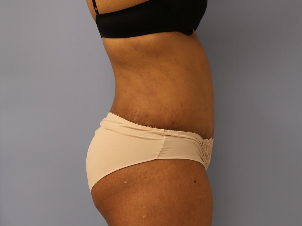 Revision Tummy Tuck Before & After Image