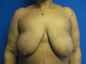 Surgery After Weight Loss Before & After Image