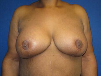 Surgery After Weight Loss Before & After Image