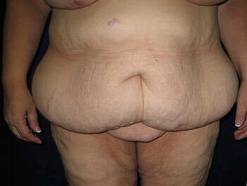 Surgery After Weight Loss Before & After Image