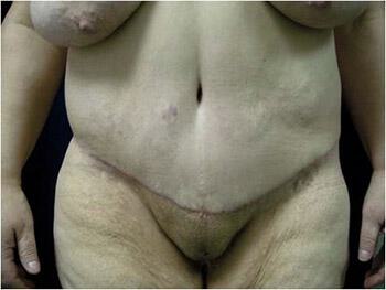 Surgery After Weight Loss Before & After Image