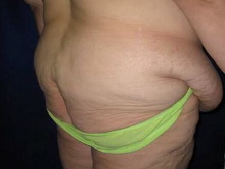 Surgery After Weight Loss Before & After Image
