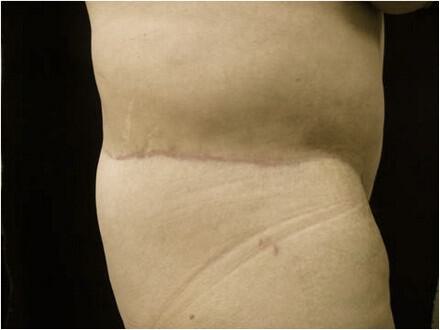 Surgery After Weight Loss Before & After Image