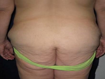 Surgery After Weight Loss Before & After Image