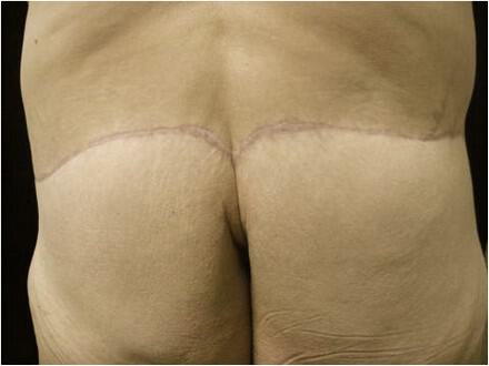 Surgery After Weight Loss Before & After Image