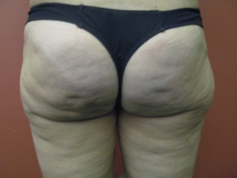 Surgery After Weight Loss Before & After Image