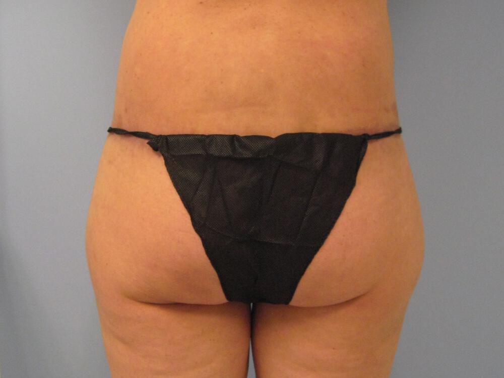 Surgery After Weight Loss Before & After Image