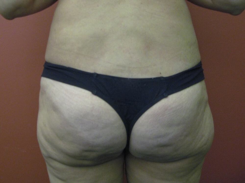 Surgery after weight loss Before & After Image