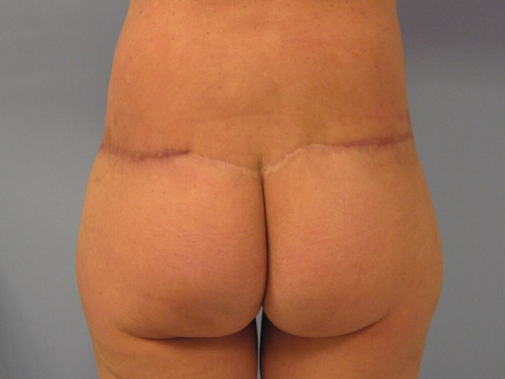 Surgery after weight loss Before & After Image