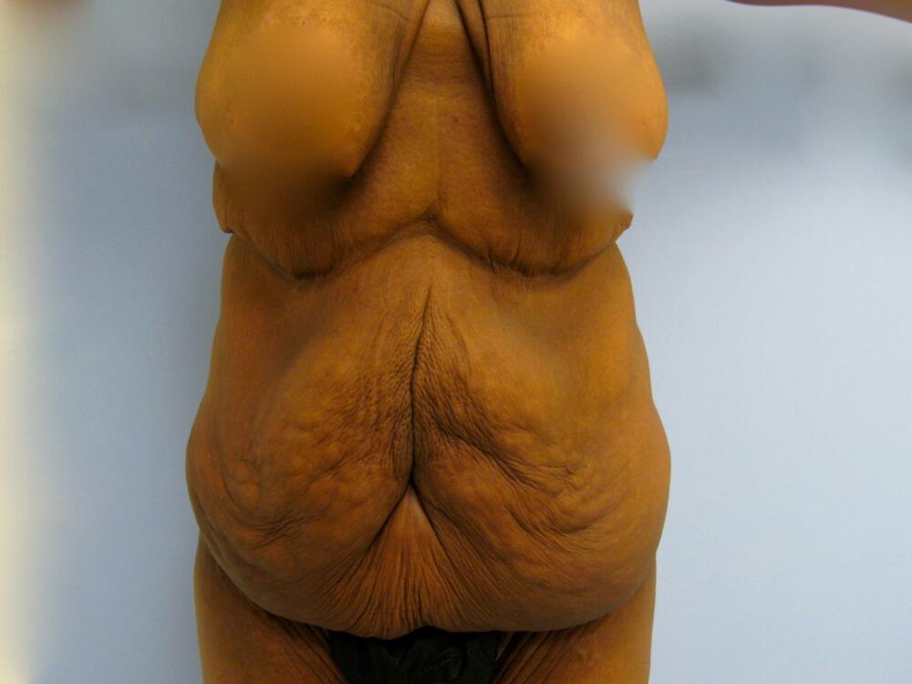 Surgery after weight loss Before & After Image