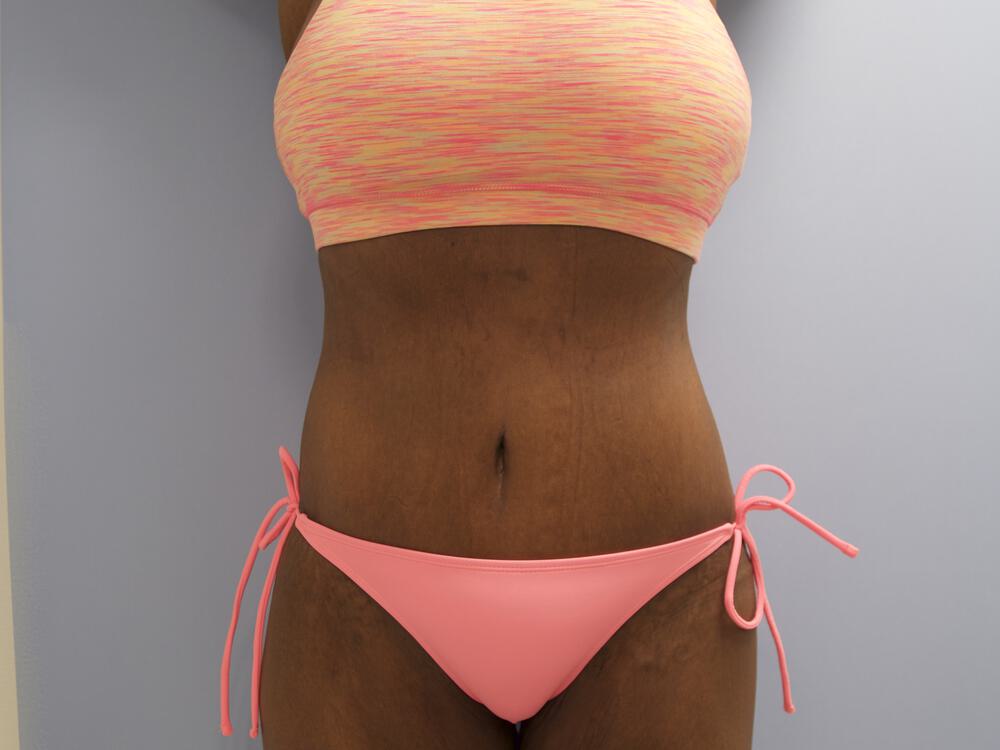 Surgery after weight loss Before & After Image