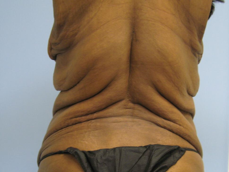 Surgery after weight loss Before & After Image