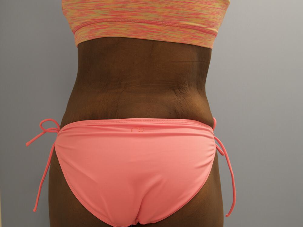 Surgery after weight loss Before & After Image