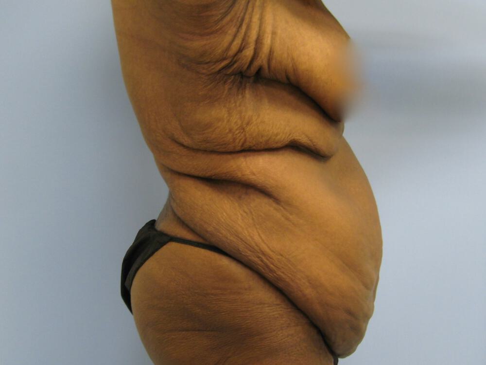 Surgery After Weight Loss Before & After Image