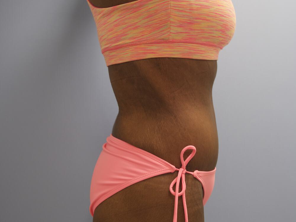 Surgery After Weight Loss Before & After Image