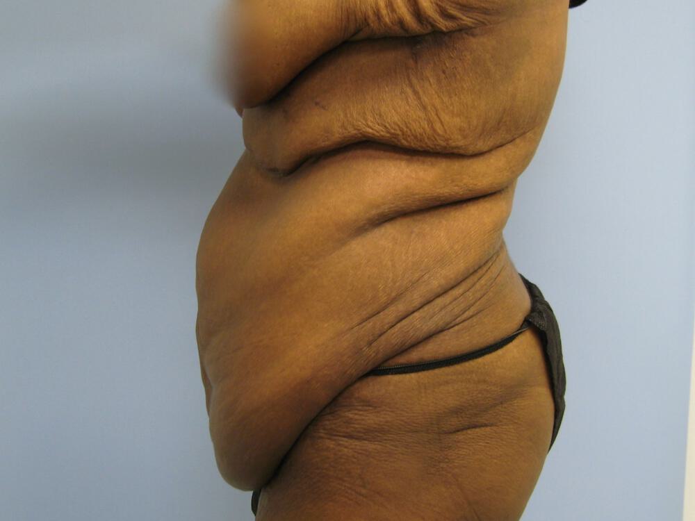 Surgery After Weight Loss Before & After Image