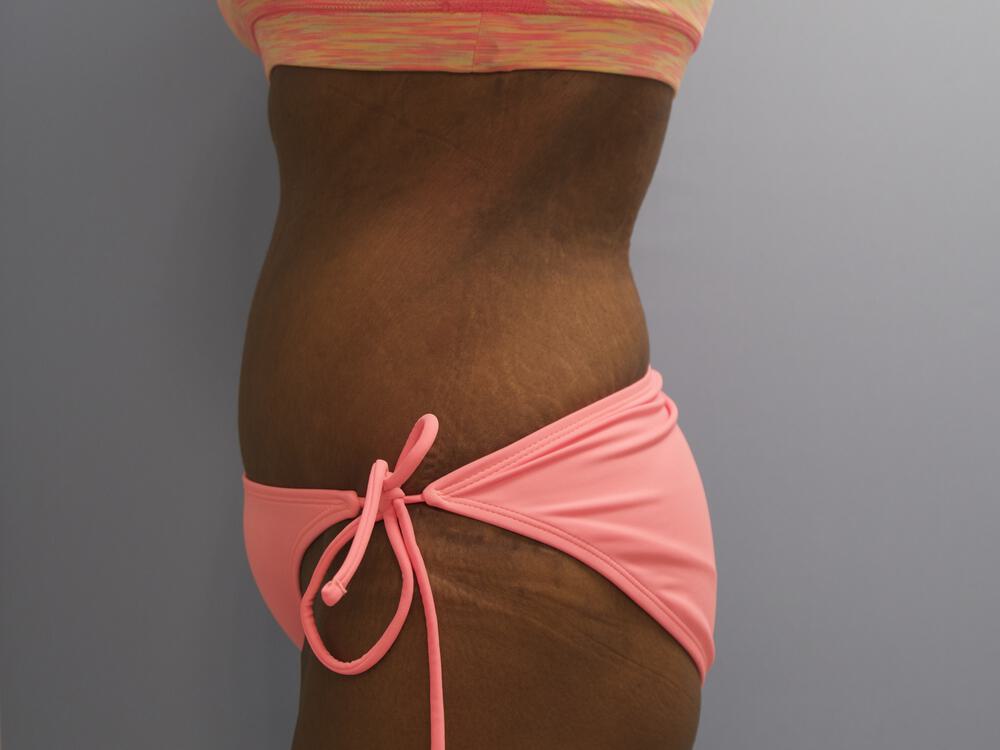 Surgery After Weight Loss Before & After Image