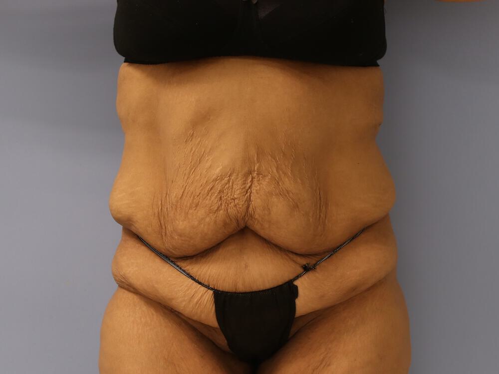 Surgery after weight loss Before & After Image