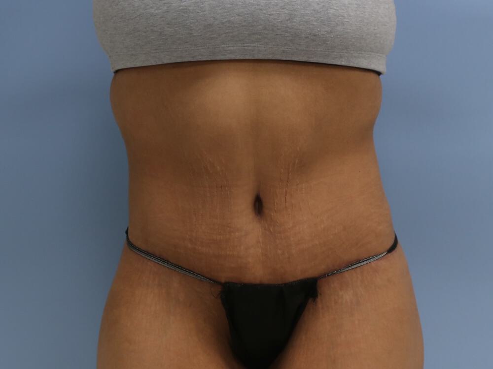 Surgery after weight loss Before & After Image