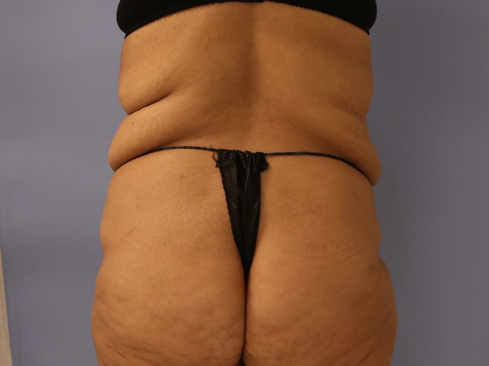 Surgery after weight loss Before & After Image