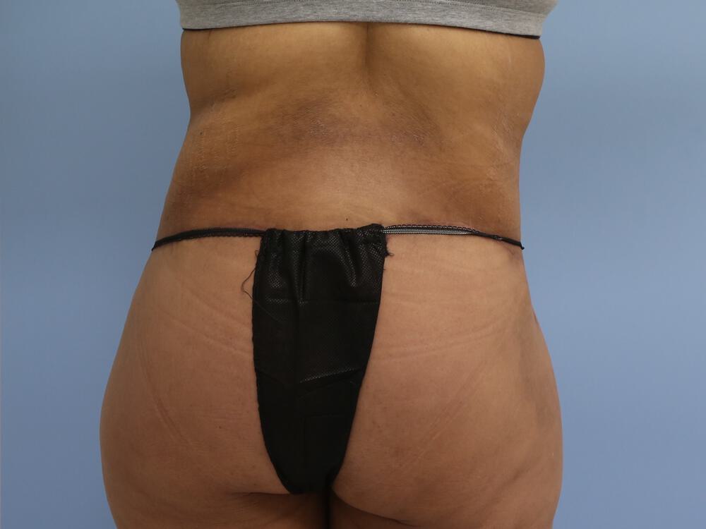 Surgery after weight loss Before & After Image