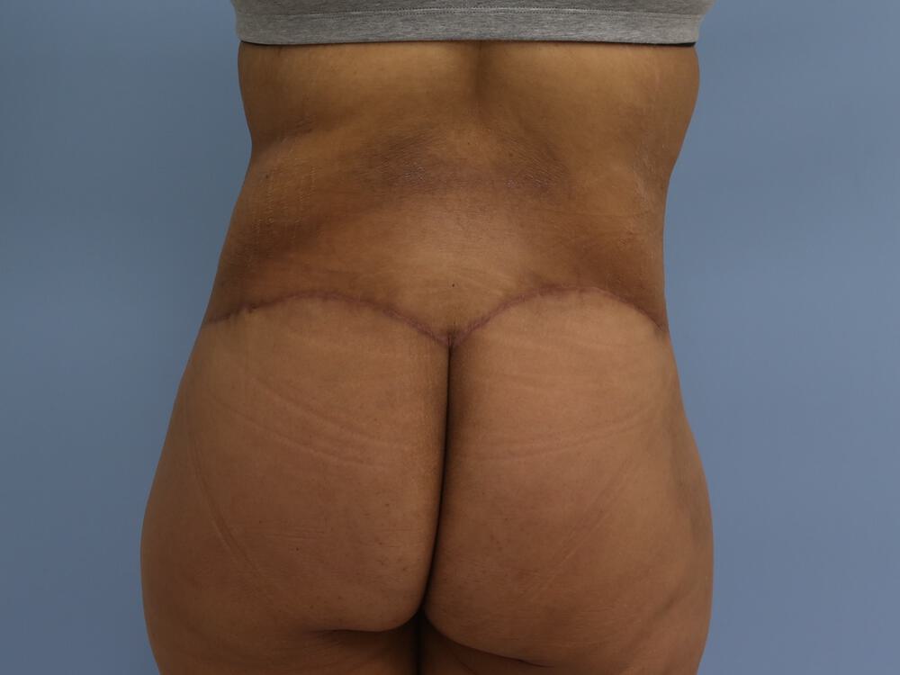 Surgery After Weight Loss Before & After Image