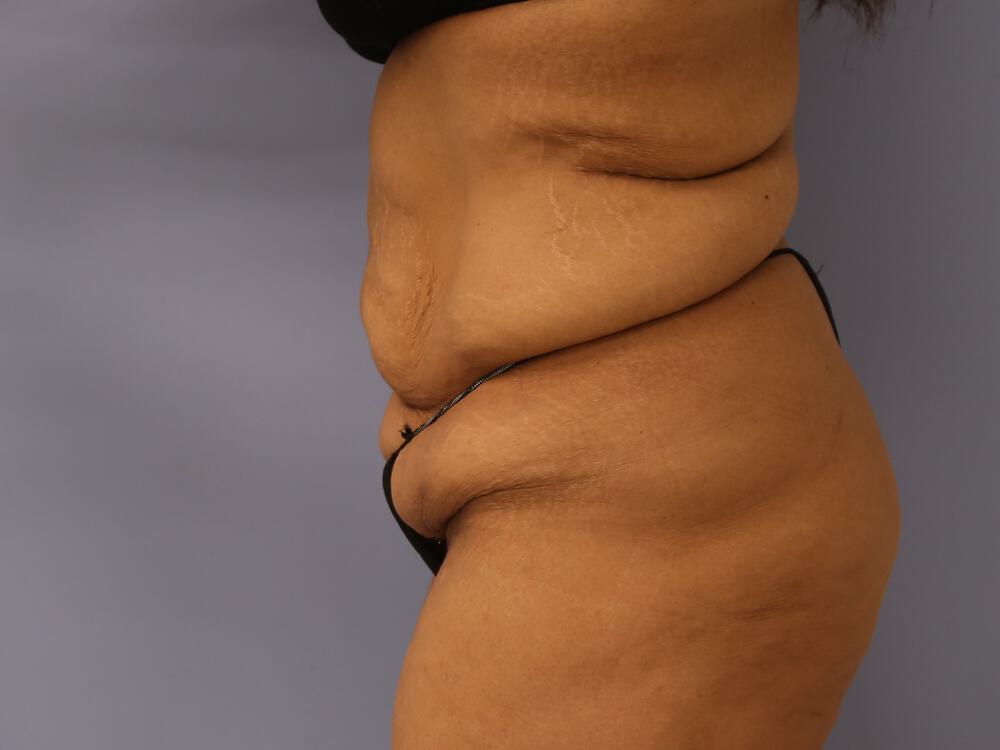 Surgery After Weight Loss Before & After Image