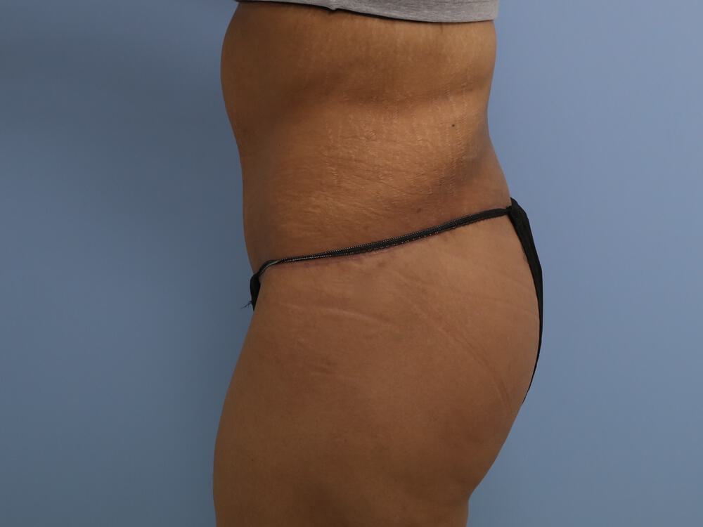 Surgery After Weight Loss Before & After Image