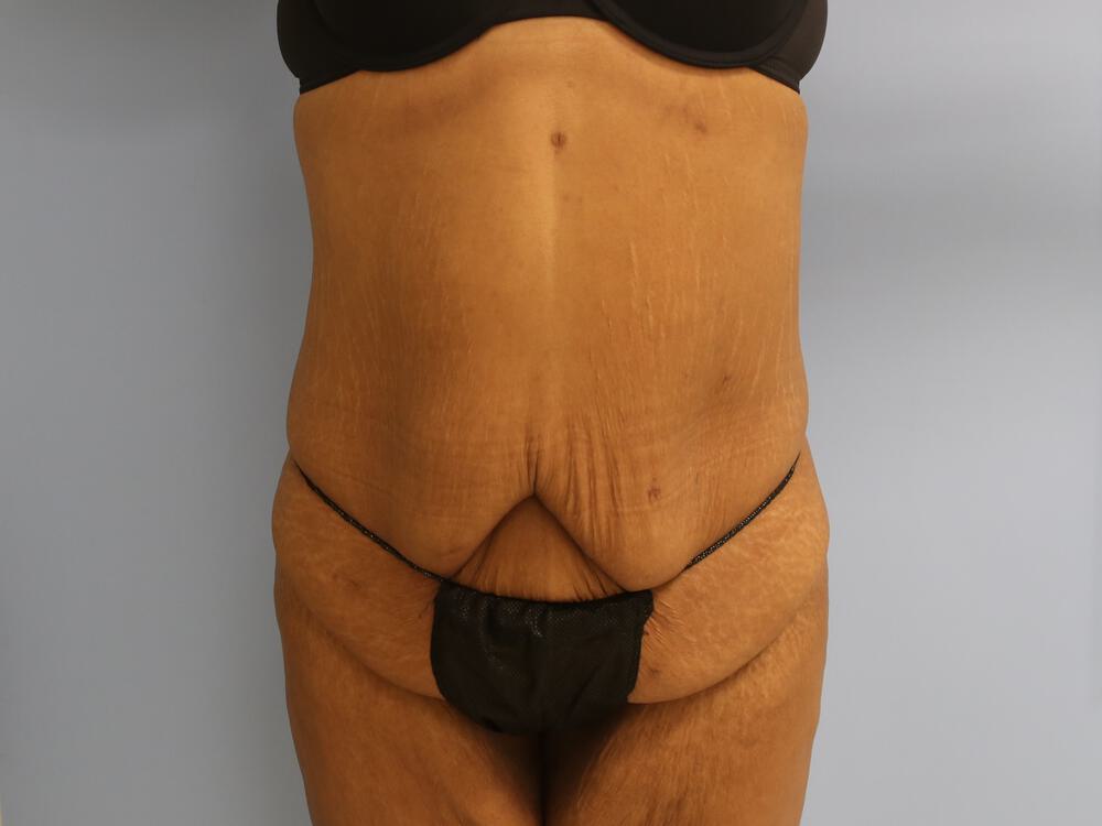 Surgery after weight loss Before & After Image