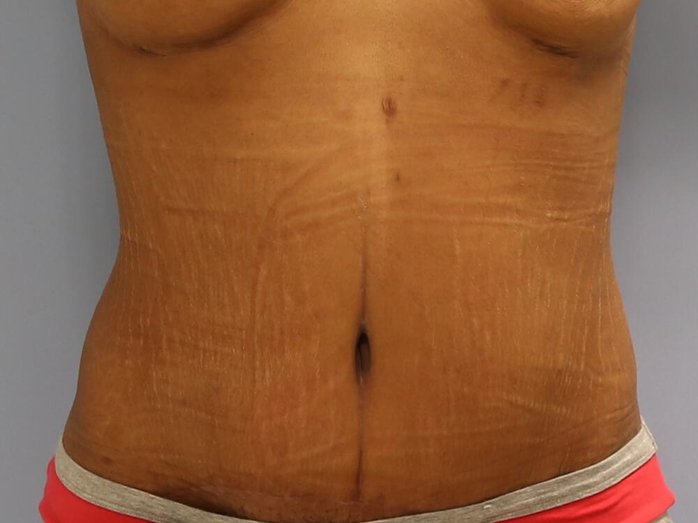 Surgery after weight loss Before & After Image