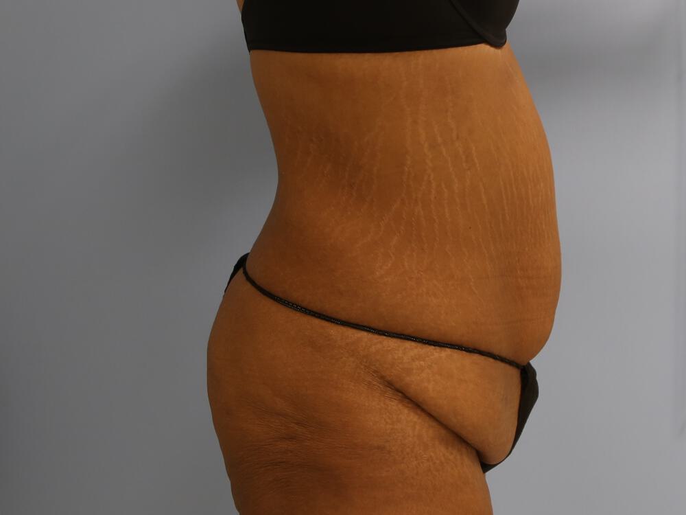 Surgery after weight loss Before & After Image