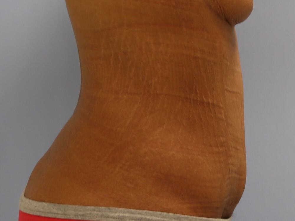 Surgery after weight loss Before & After Image