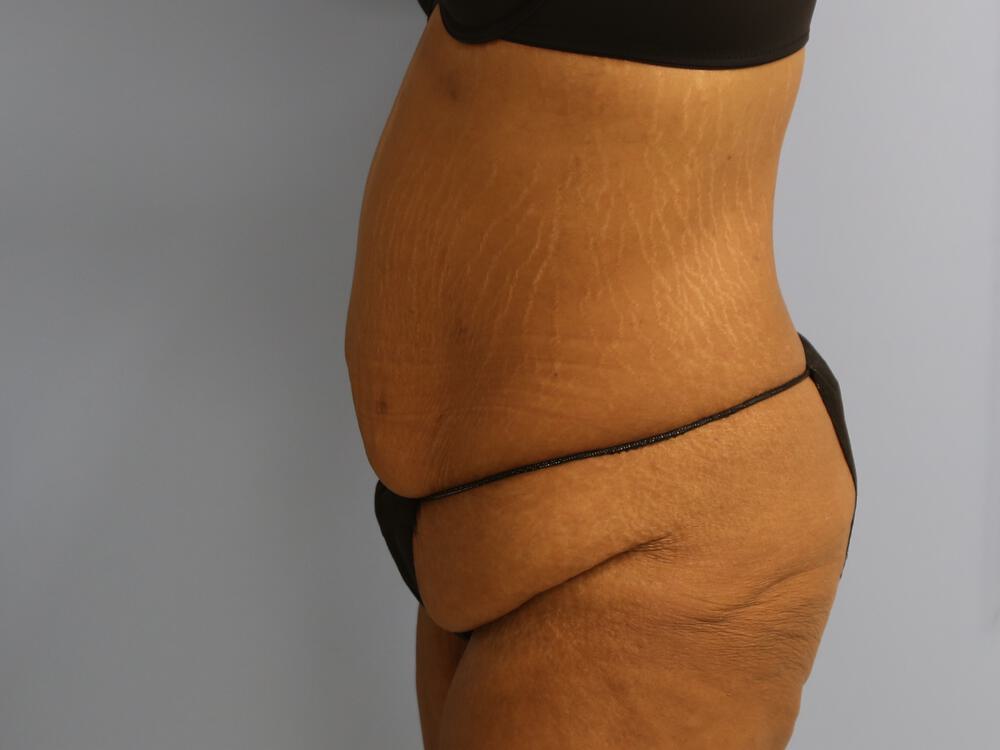 Surgery After Weight Loss Before & After Image