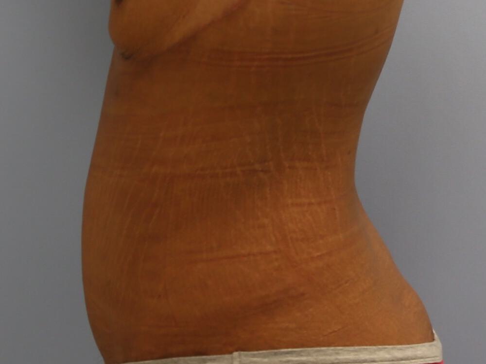 Surgery After Weight Loss Before & After Image